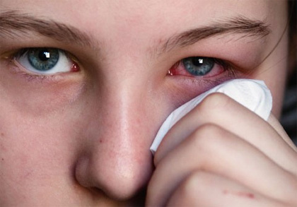 Cách phòng ngừa bệnh đau mắt đỏ